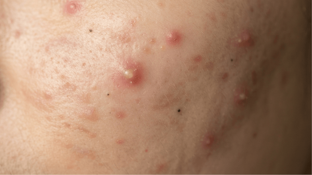 Acne on medium skin. Raised pink-red spots across the cheek and jaw, some with white heads, alongside flat brown marks left behind by spots that have already cleared.