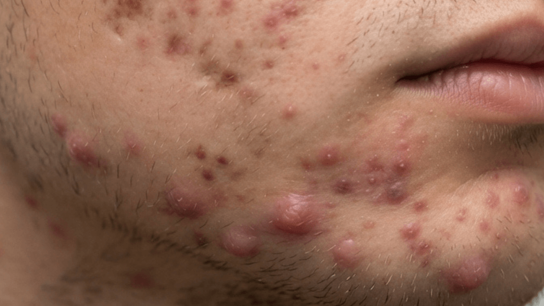 Nodular