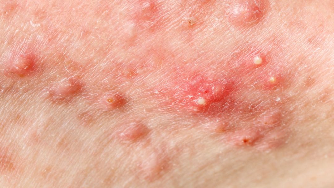 Inflammatory