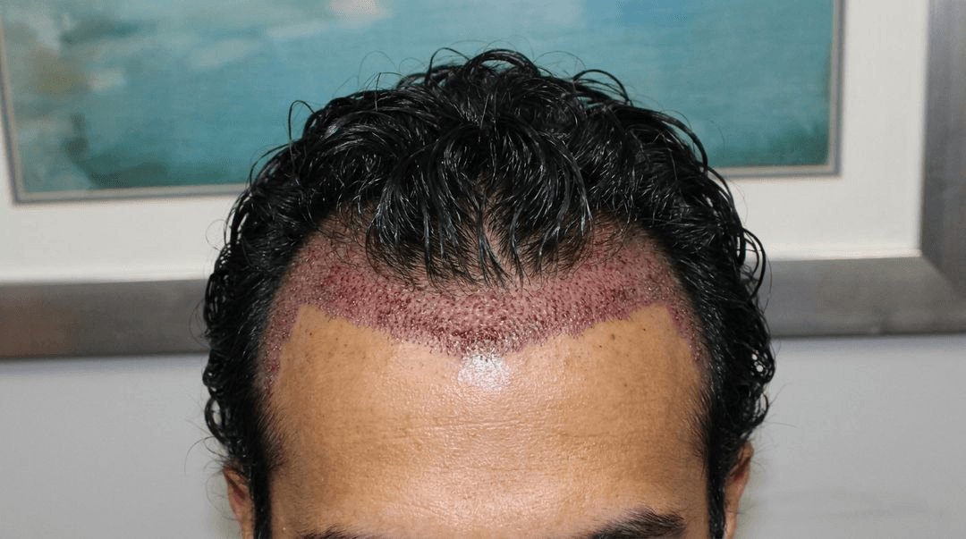 Hair transplant