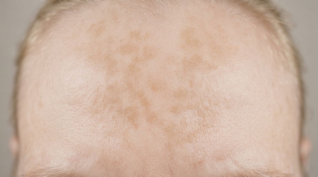 Flat tan patches with soft irregular edges across the forehead and upper cheek of an adult with light skin, the surface completely smooth.