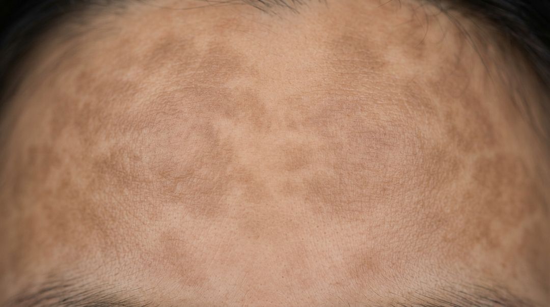 Forehead