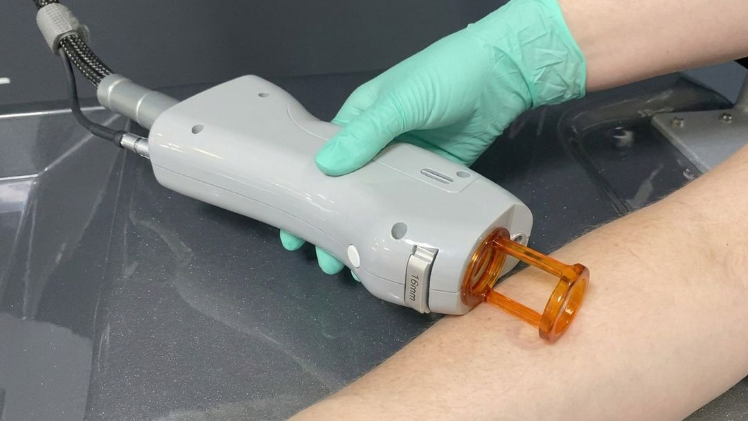 A gloved hand guiding a laser handpiece along a patient's lower leg