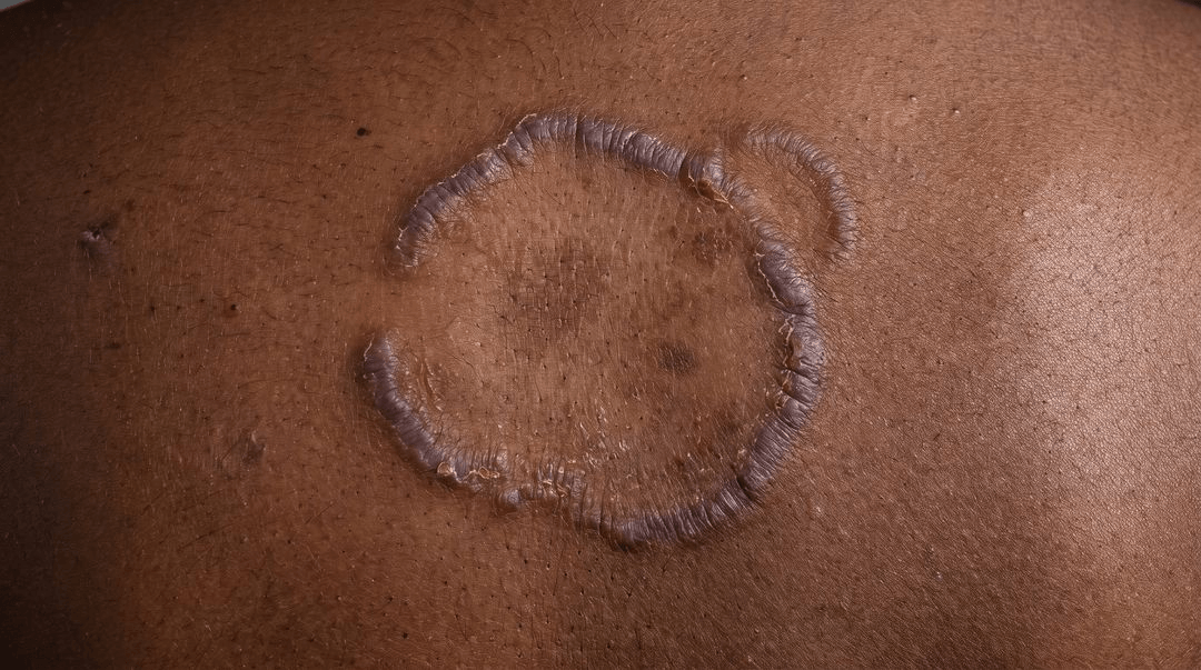 A round patch on a forearm on deep dark brown skin. The raised scaly border is barely darker than the skin around it, and the flatter middle is visible mainly by its smoother texture.