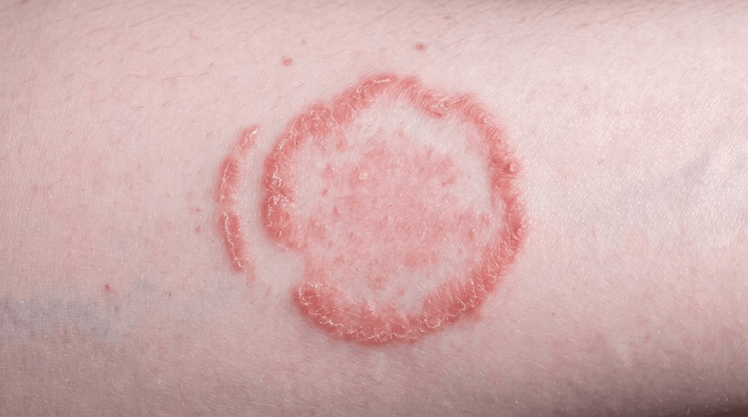 A round patch on a forearm on fair light skin, with a raised pink scaly border and a flatter, clearer middle.