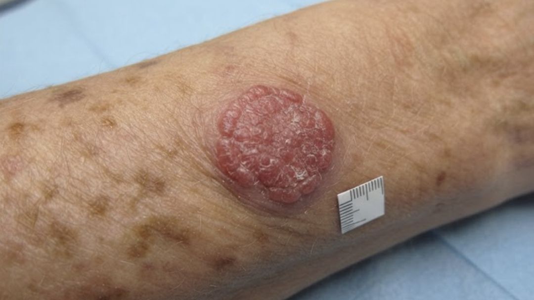 Squamous Cell Carcinoma