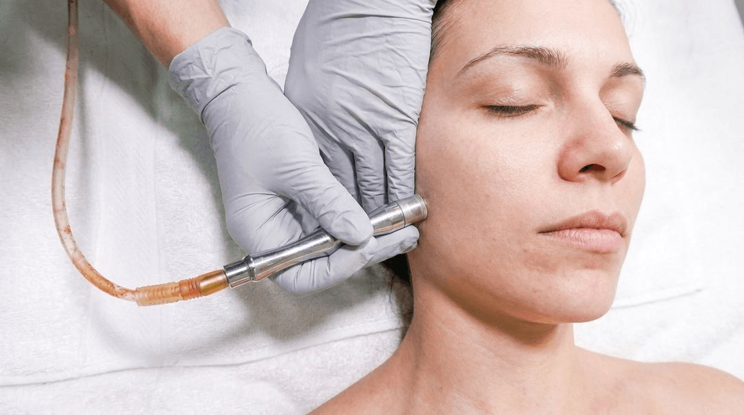 Microdermabrasion