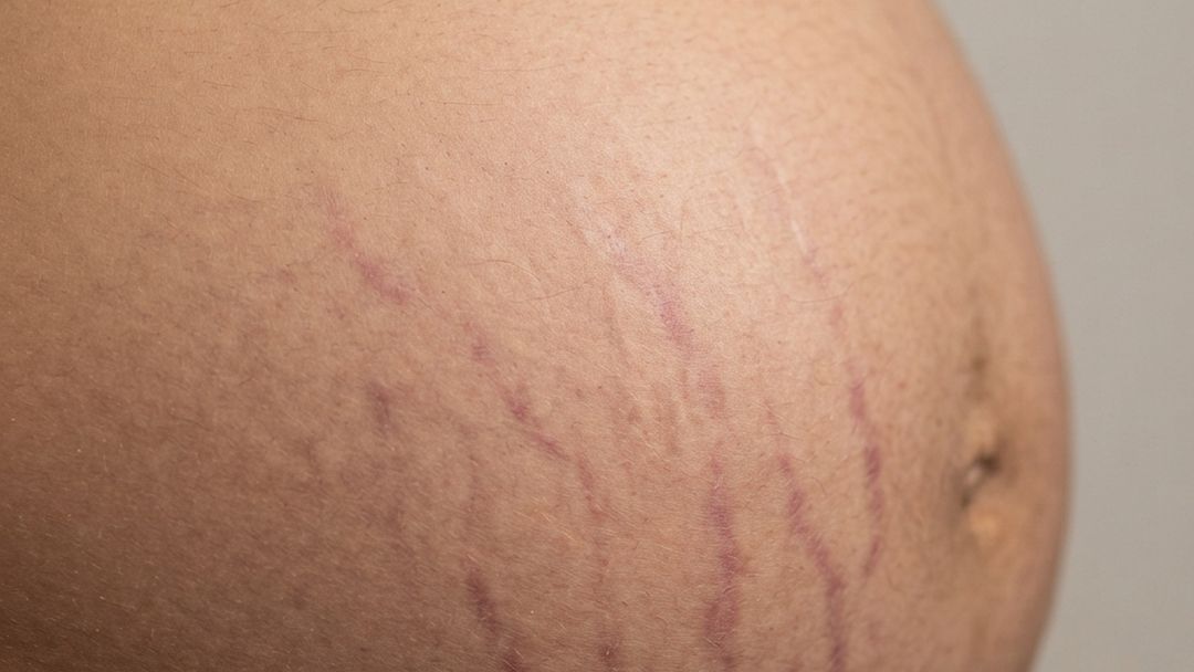 Stretch Marks