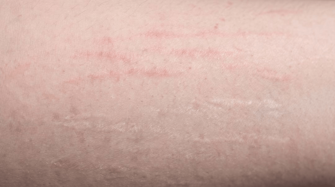 Two areas of fair skin side by side on a hip. New pink-red bands sit above, and older flat silvery-white bands below, with only a small difference in color between the pale marks and the skin around them.