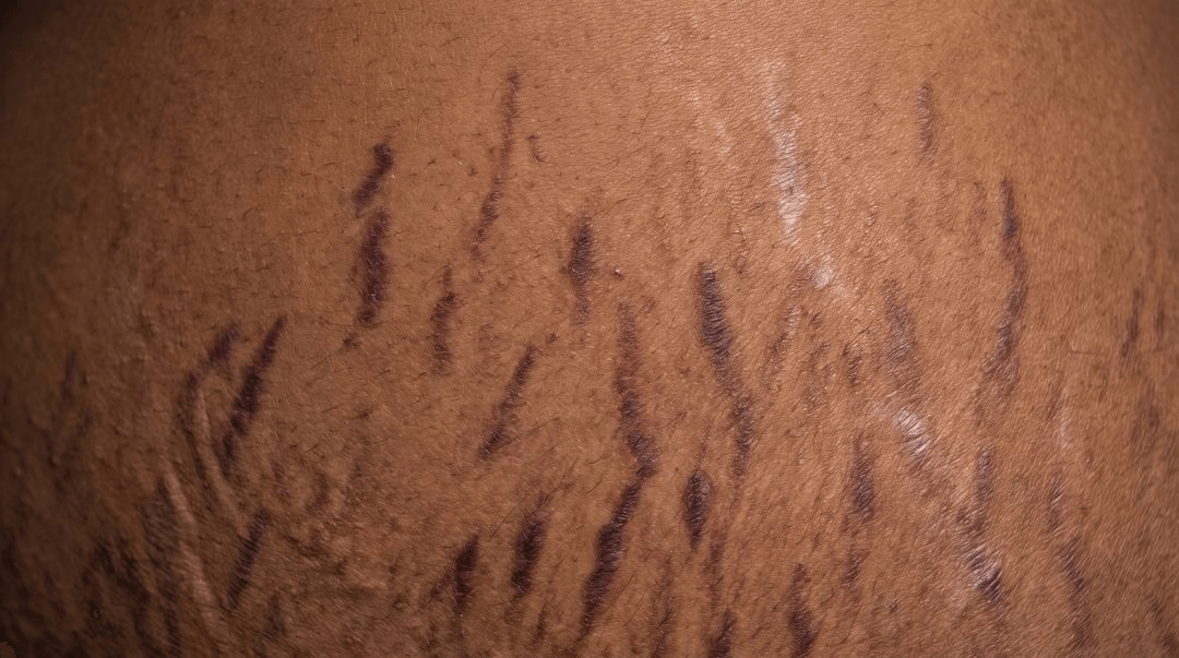 Deep violet-brown parallel bands across the shoulders and upper back of brown skin, running outward from the spine, with two older pale bands among them that stand out clearly against the surrounding skin.