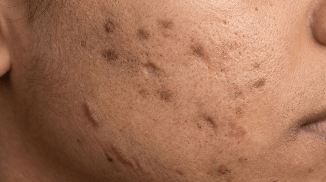 Acne scarring on brown skin. Flat dark brown marks cover much of a cheek and jaw, with shallow dips and one or two firm raised scars along the jawline showing through them.