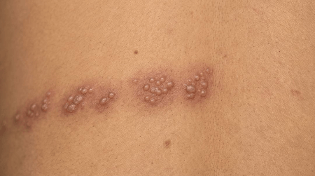 A band of small grouped blisters on medium olive-tan skin, curving from the spine around one side of the ribcage. The skin under the blisters is dusky pink-brown, and the band stops at the middle of the back.