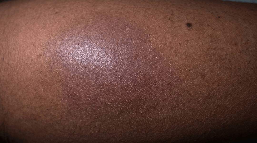 One lower leg on deep brown skin with a large swollen, tight-looking area that is only slightly darker and grayer than the skin beside it. The color change is very subtle and has no clear edge.