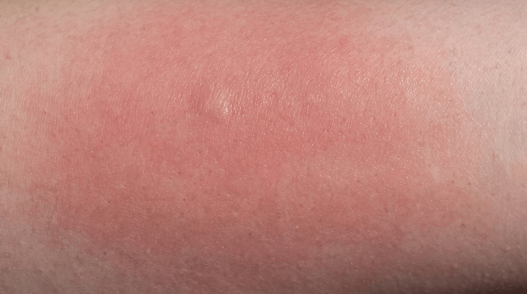 One lower leg on light skin with a large bright pink-red area that is swollen and tight-looking, with a shiny surface and a blurred edge where it fades into normal skin.