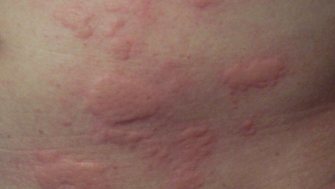 Hives (Urticaria)