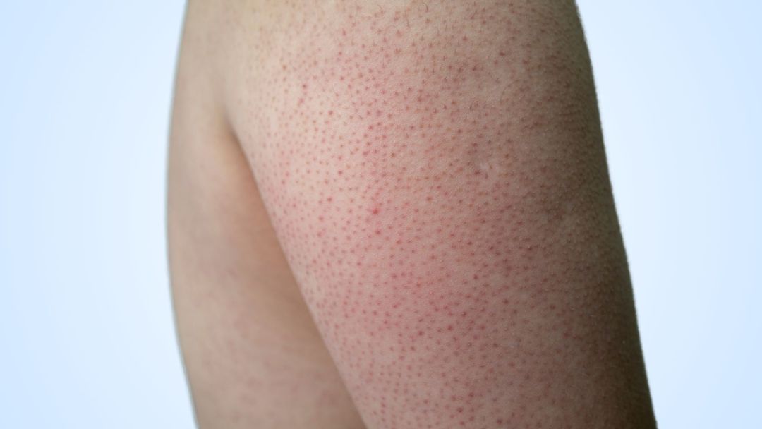 Keratosis Pilaris