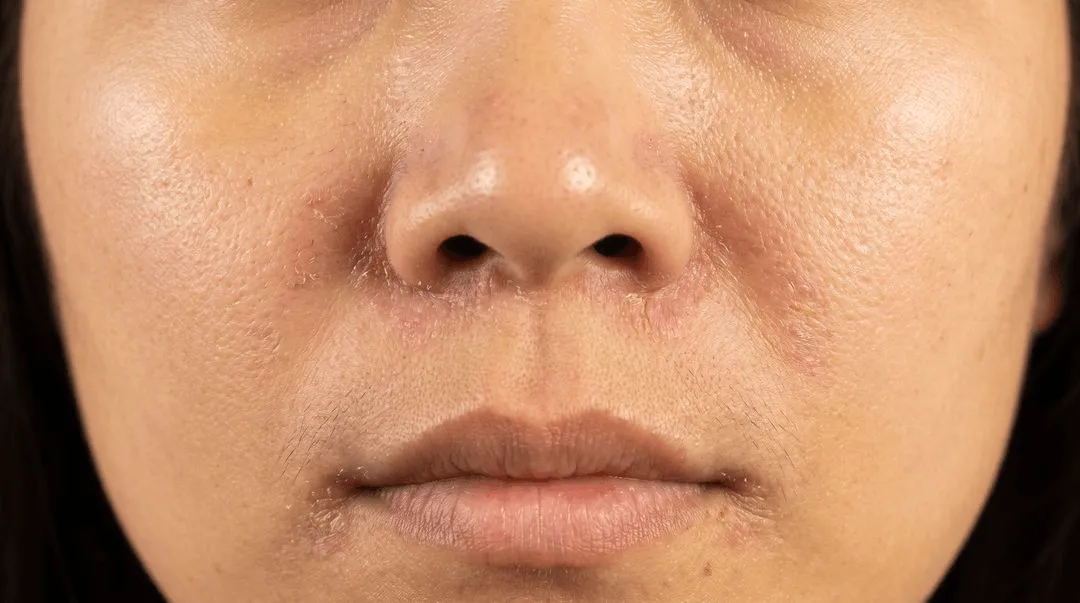 Dull pink-brown patches with greasy scale through an eyebrow and beside the nose on medium olive skin, one of them slightly lighter than the surrounding skin at its center.