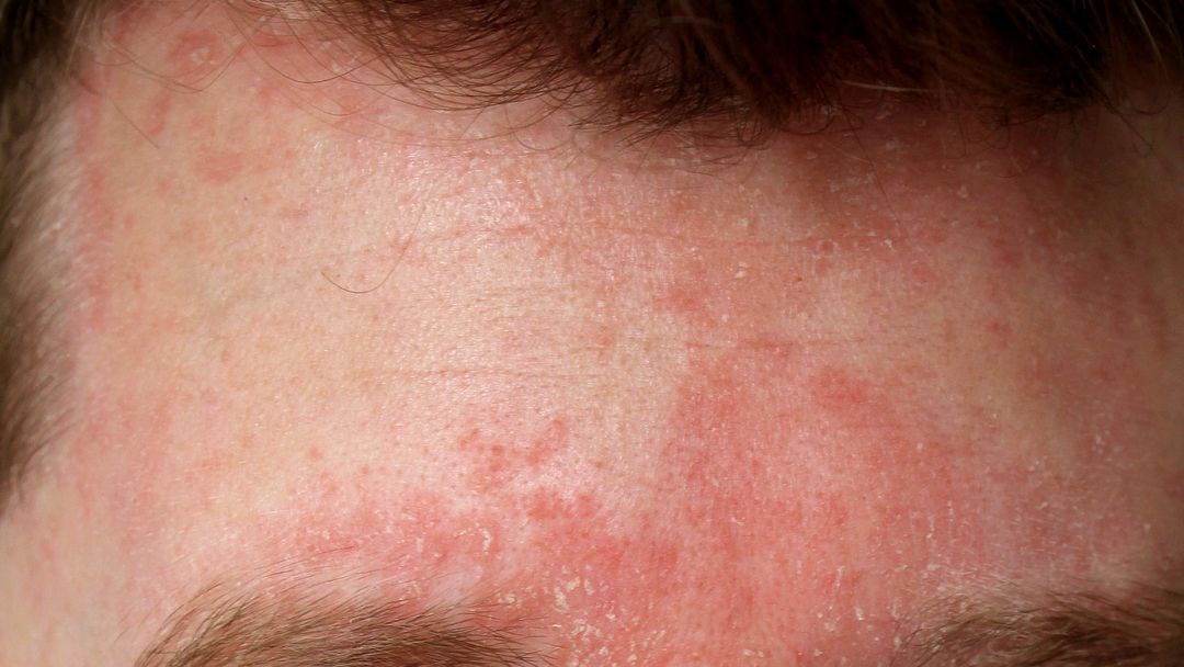 Seborrheic Dermatitis