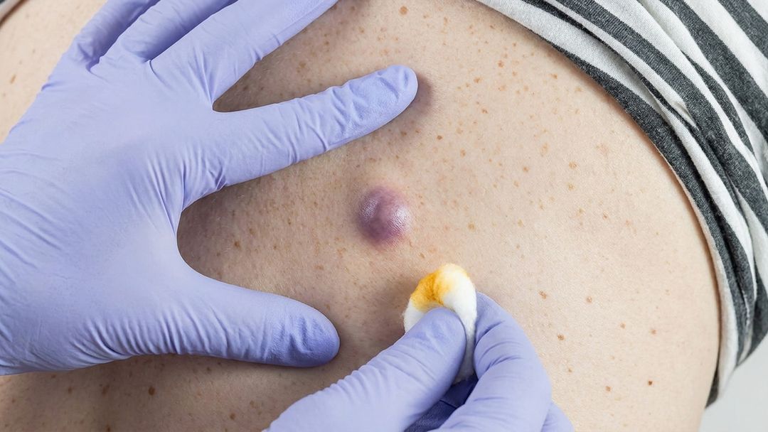 Cyst Removal — Page hero A gloved clinician draining a cyst on a patient's upper arm with gauze held alongside it