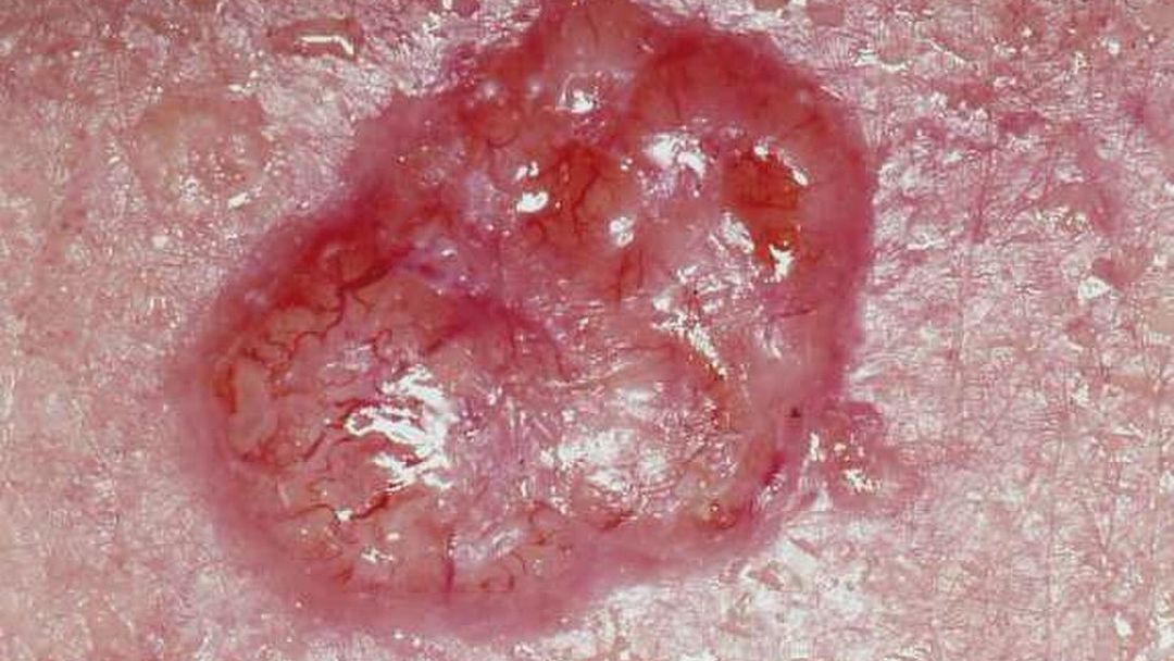 Basal Cell Carcinoma
