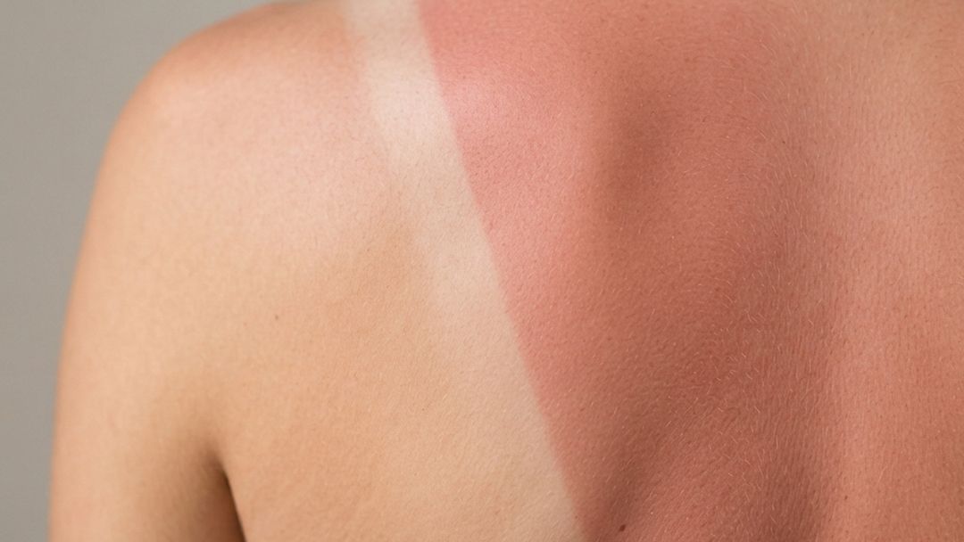 Sunburn