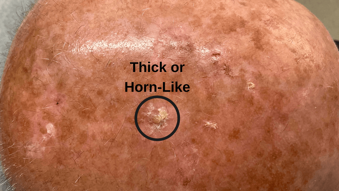 Thick or Horn-Like