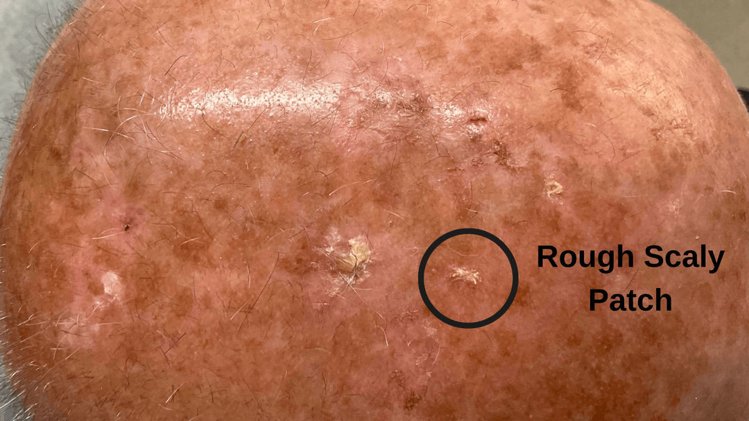 Rough Scaly Patch