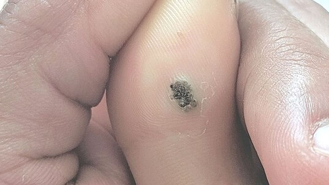 Warts