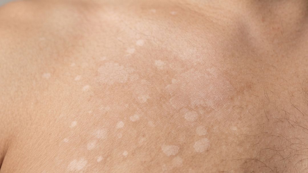 Tinea Versicolor