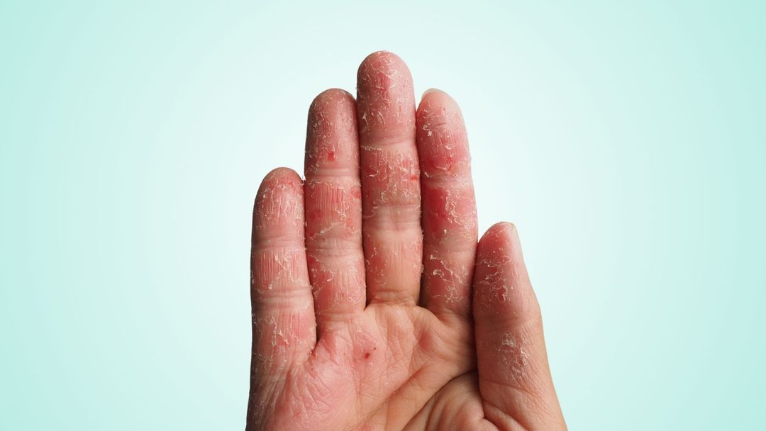 Hand Dermatitis