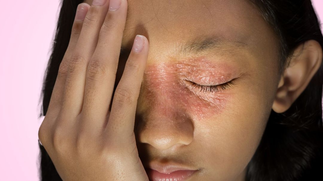 Eyelid Dermatitis