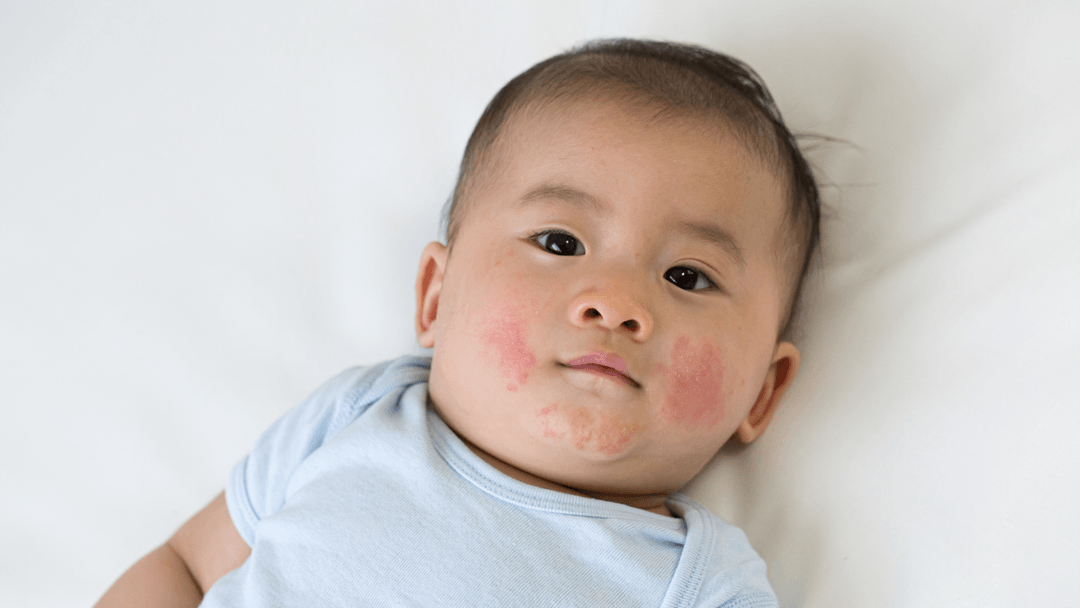 Atopic Dermatitis