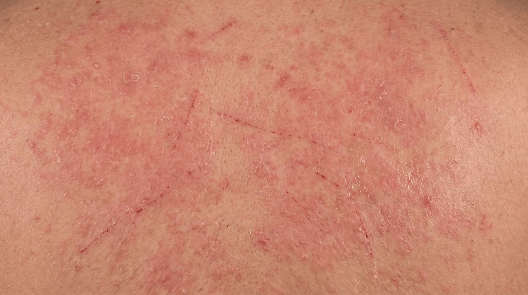Extreme close-up of medium, olive-toned skin in an active eczema flare, too close to tell which part of the body it is. Blotchy brick-red inflammation covers the whole frame with no clear edge, with small raised bumps, fine dry scale and a few fresh scratch marks.