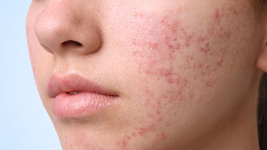 Close-up of the lower cheek, mouth and jaw of a young person with light skin, turned three-quarters away from the camera against a pale blue background. Scattered flat pink-red marks cover the cheek and run down towards the jaw. The skin surface is smooth and even, with no raised spots and no change in texture.