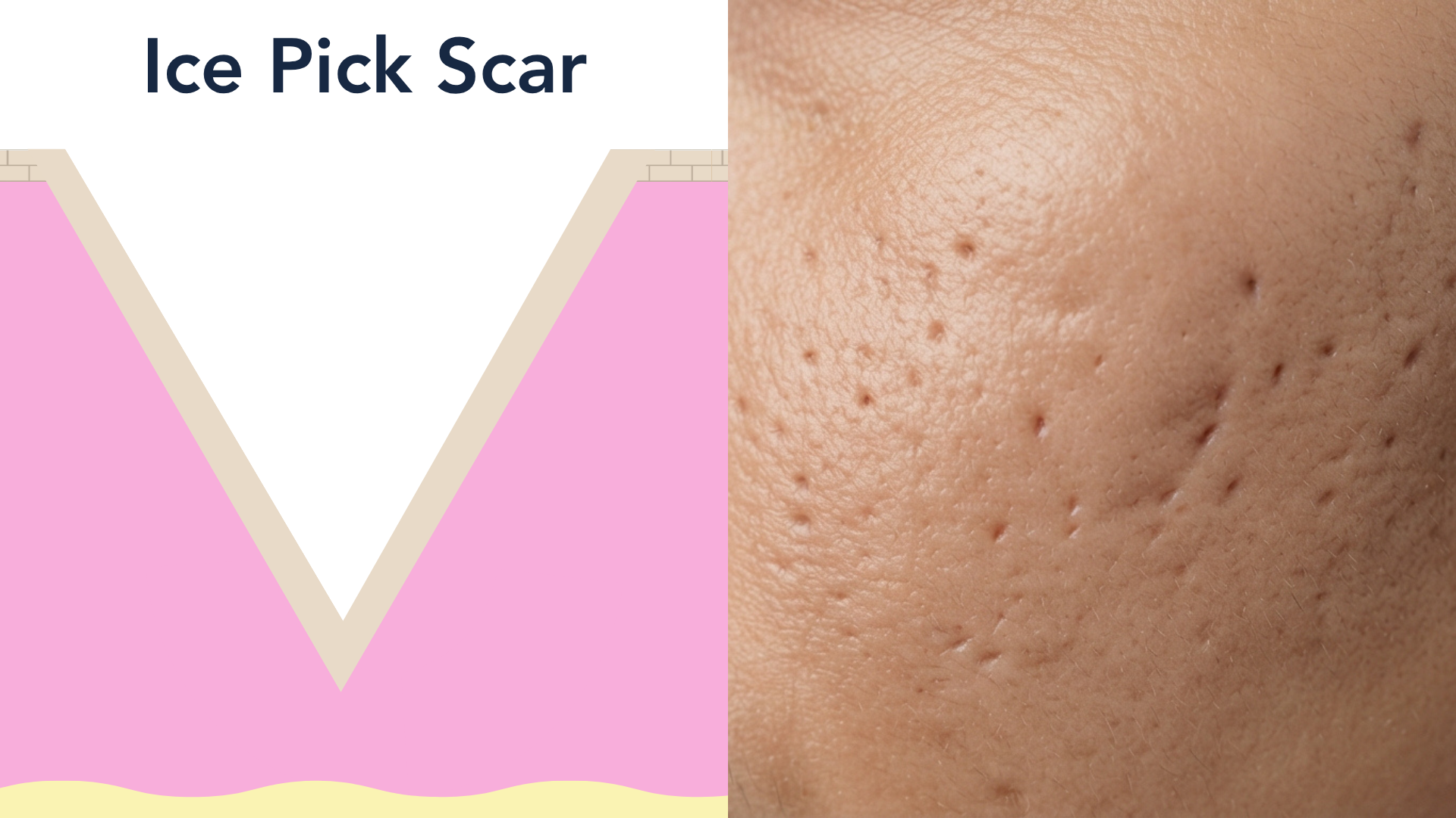 Panel 1 of the acne scarring figure. A cross-section of skin with a narrow, V-shaped track running from the surface straight down deep into the dermis.