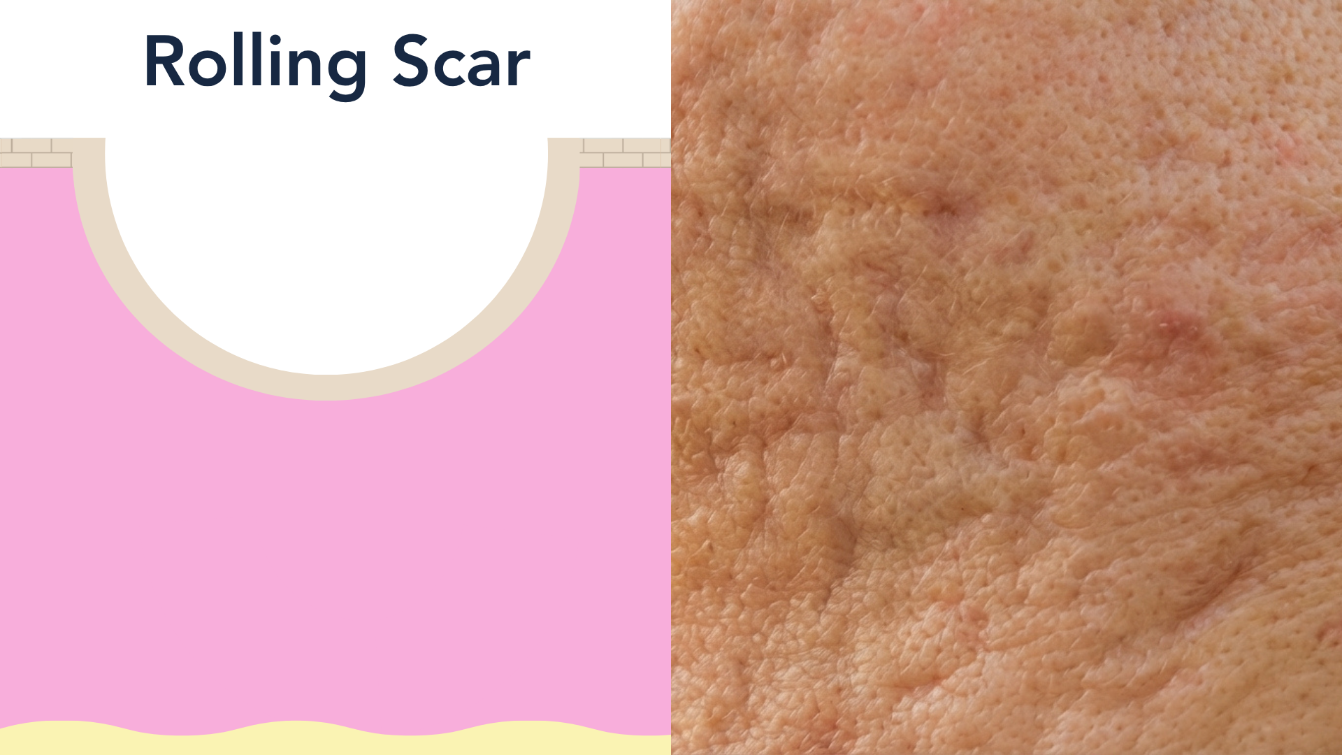 Panel 3 of the acne scarring figure. A cross-section of skin with a broad, shallow, curved depression, the surface layer unbroken and fibrous bands tethering it from beneath.