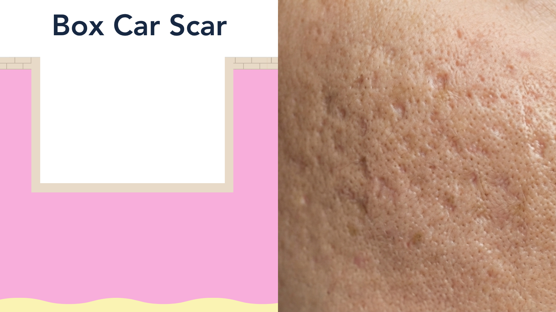 Panel 2 of the acne scarring figure. A cross-section of skin with a wide depression that has steep straight sides and a flat base within the dermis.