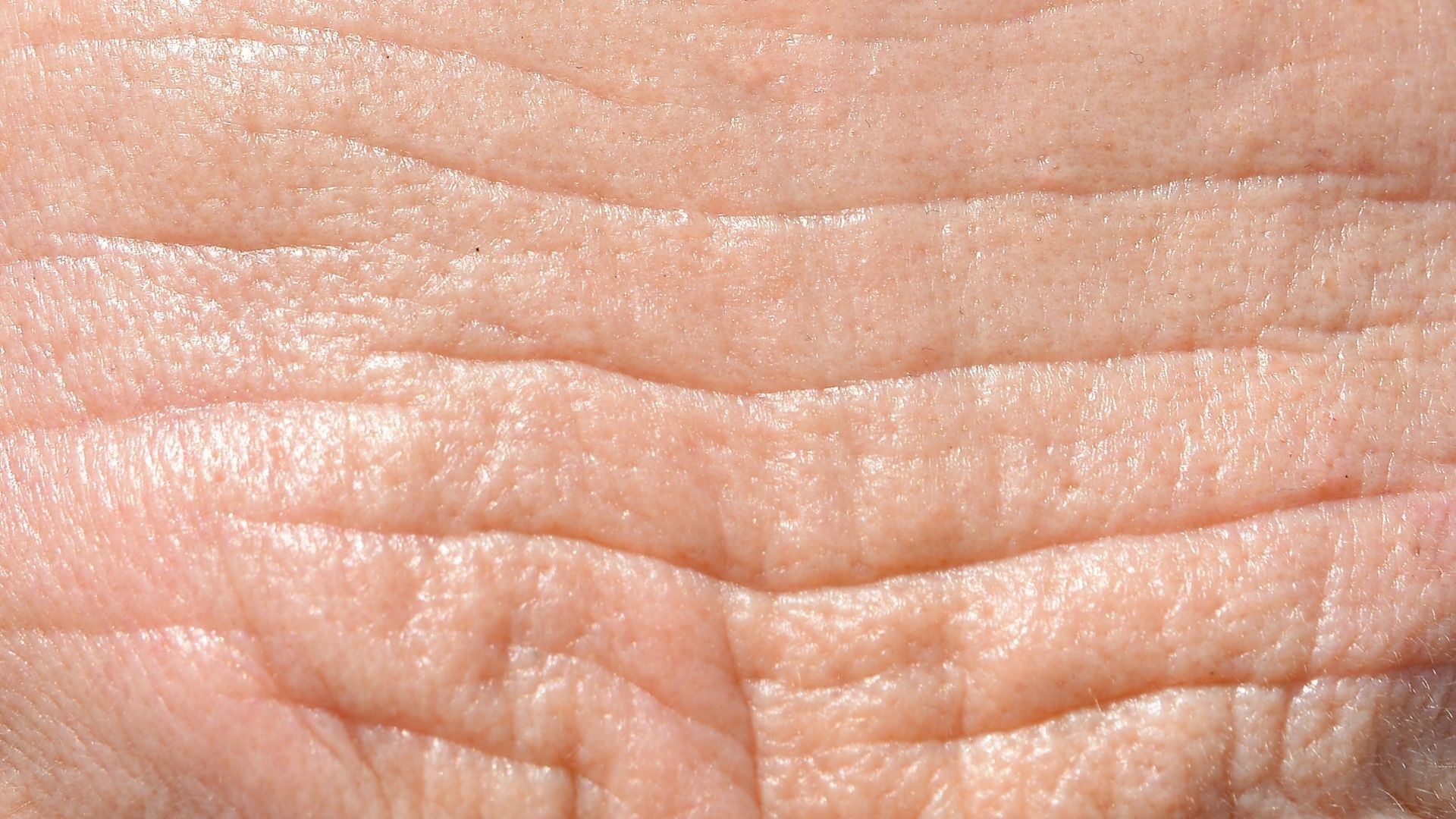 Wrinkles and Fine Lines