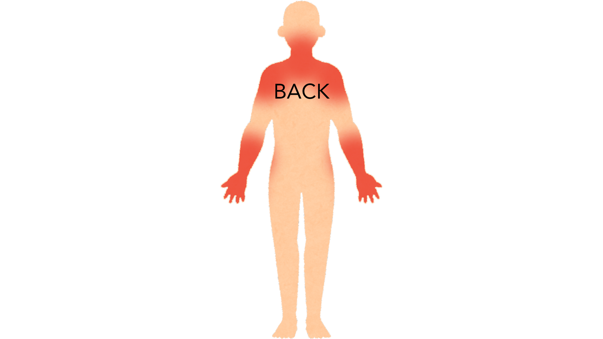 Back view of a whole body with red marks on the back of the neck, on both shoulders, on both forearms and on the backs of both hands. The rest of the body is clear.