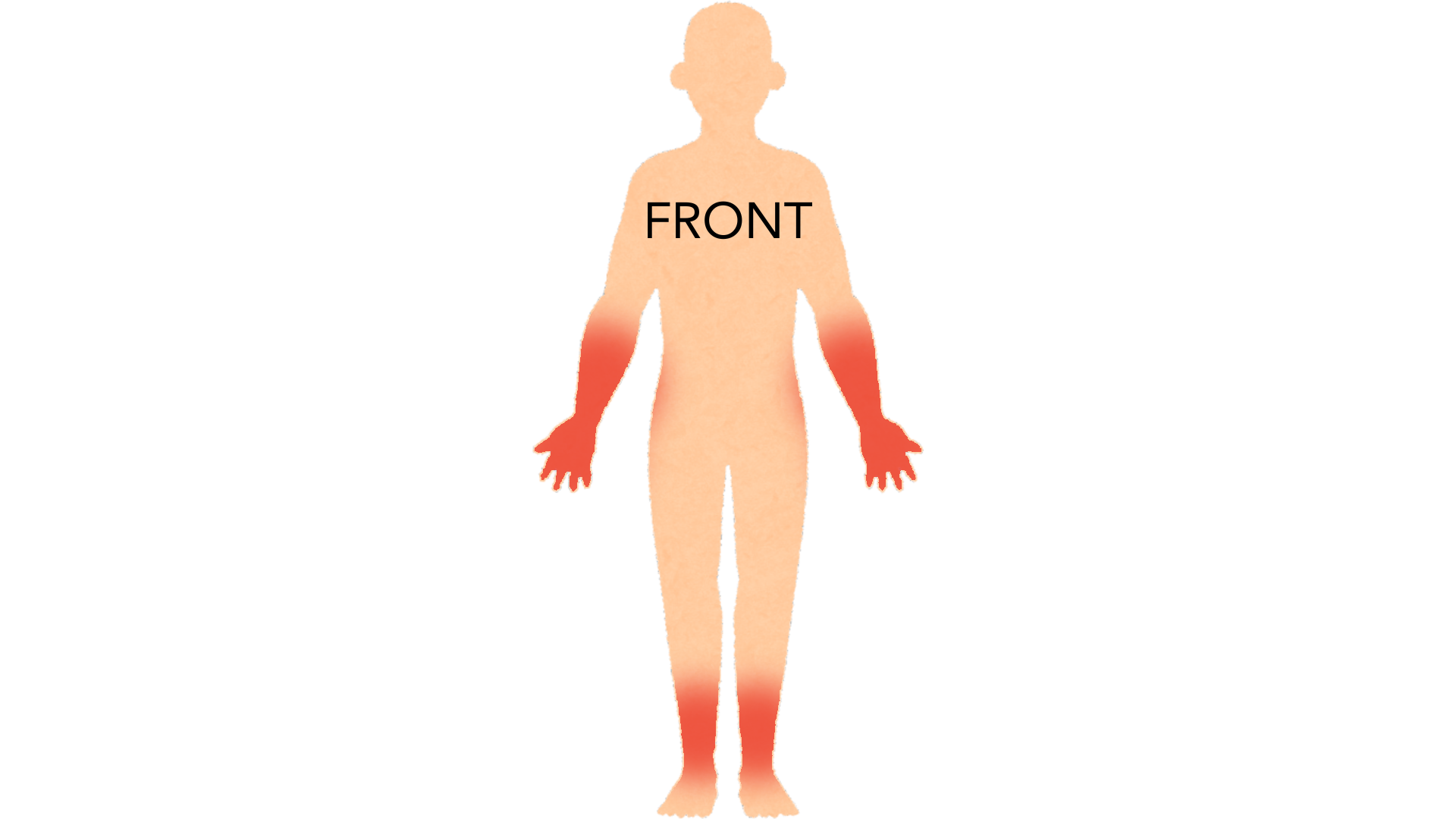 Front view of a whole body with red marks on both forearms, on the backs of both hands and on both shins. The rest of the body is clear.
