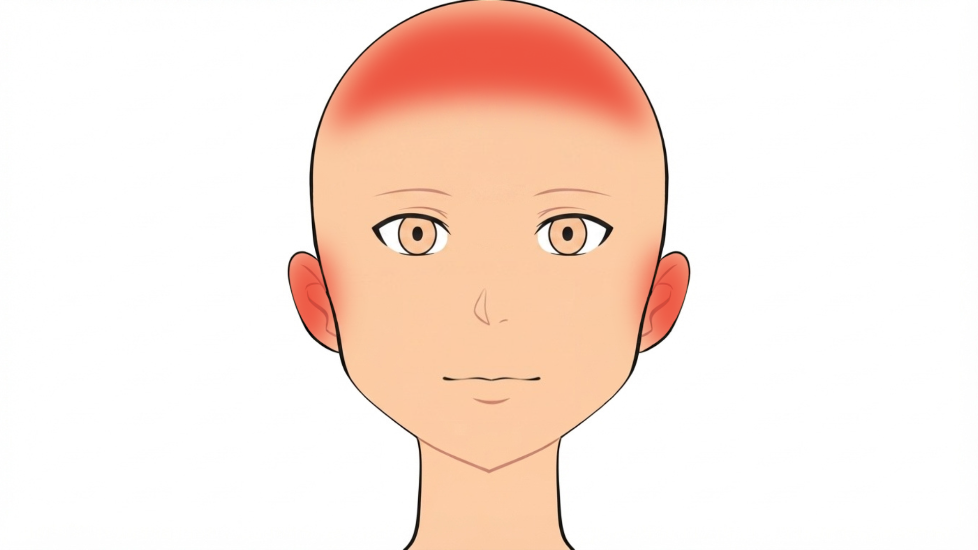 Front view of a head with red marks across the scalp, along the hairline and behind both ears.