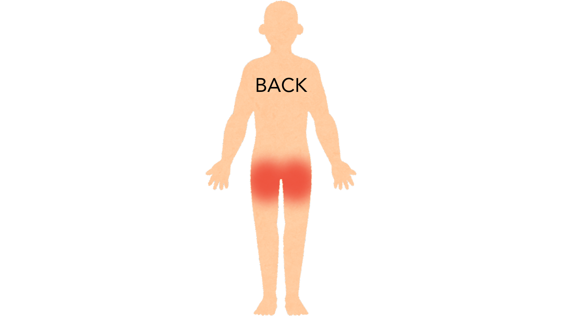 Back view of a whole body with red marks on both buttocks. The rest of the body is clear.