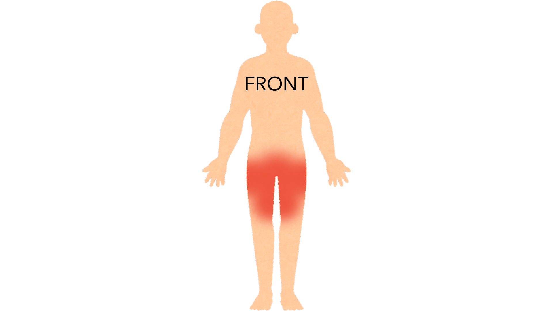 Front view of a whole body with red marks in both groin creases, across the hips and down both inner thighs. The rest of the body is clear.