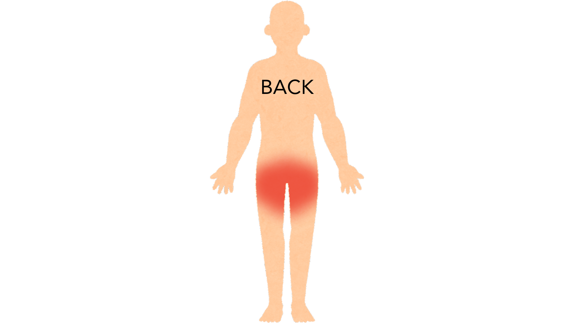 Back view of a whole body with red marks on both buttocks and in the crease between them. The rest of the body is clear.