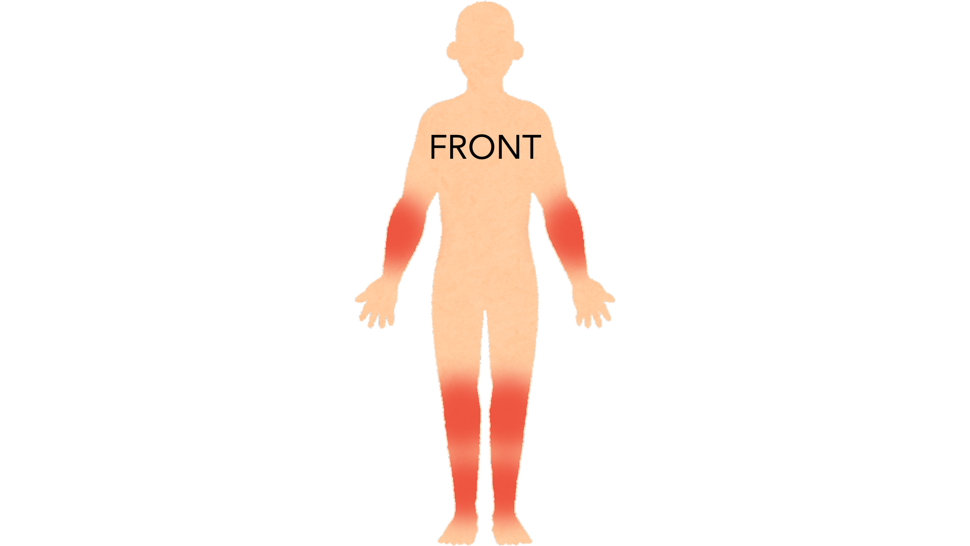 Front view of a whole body with red marks on the outside of both elbows, on both knees and down both shins.