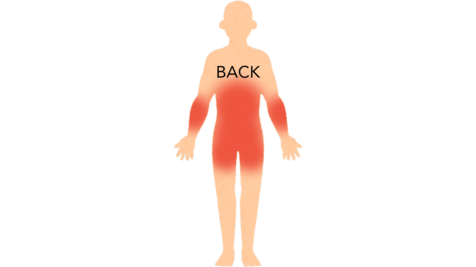 Back view of a whole body with red marks across the lower back, in the crease between the buttocks, on the middle back and on both elbows.