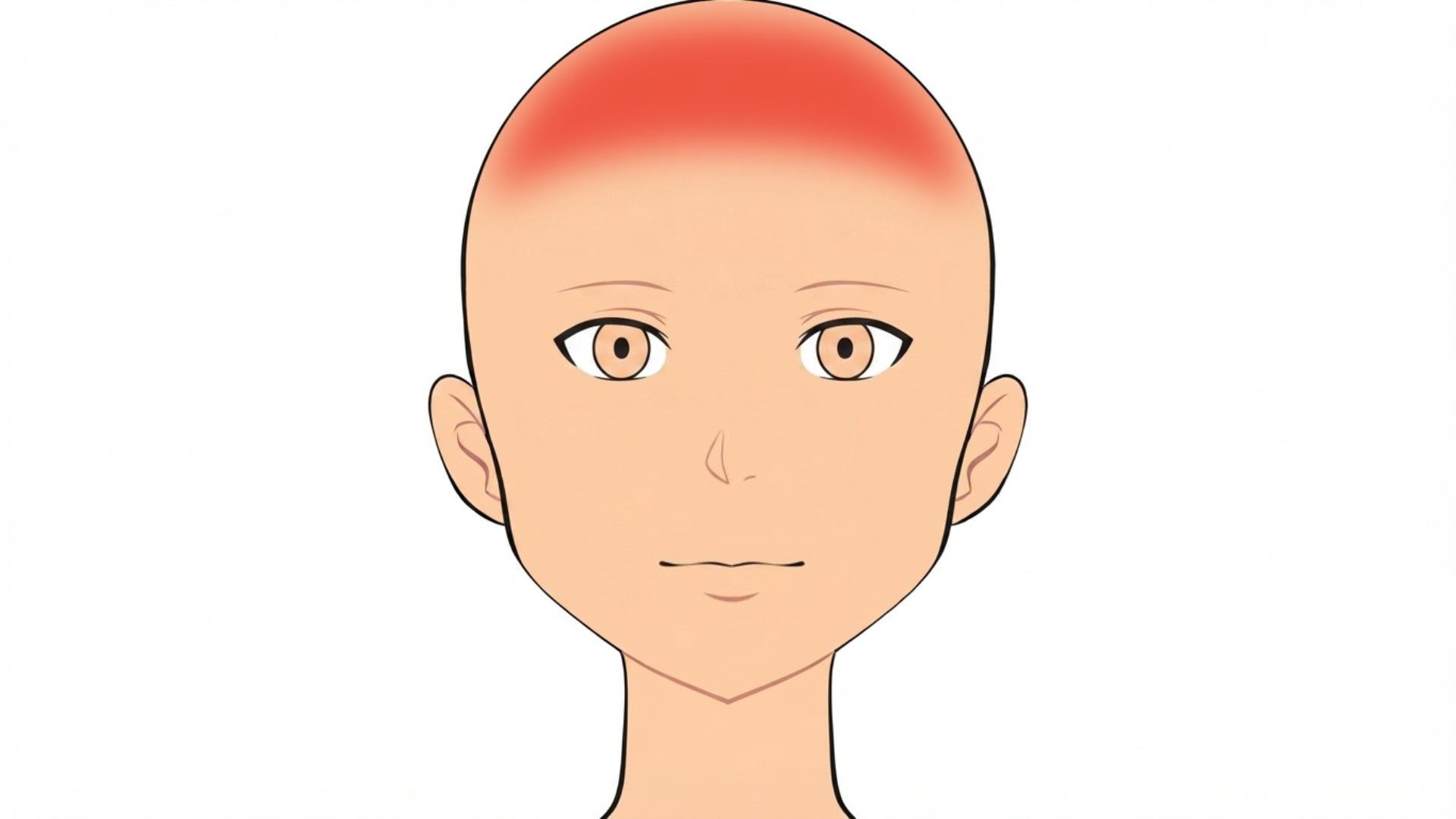 Front view of a head with red marks spread across the whole scalp and along the hairline. The face is clear.