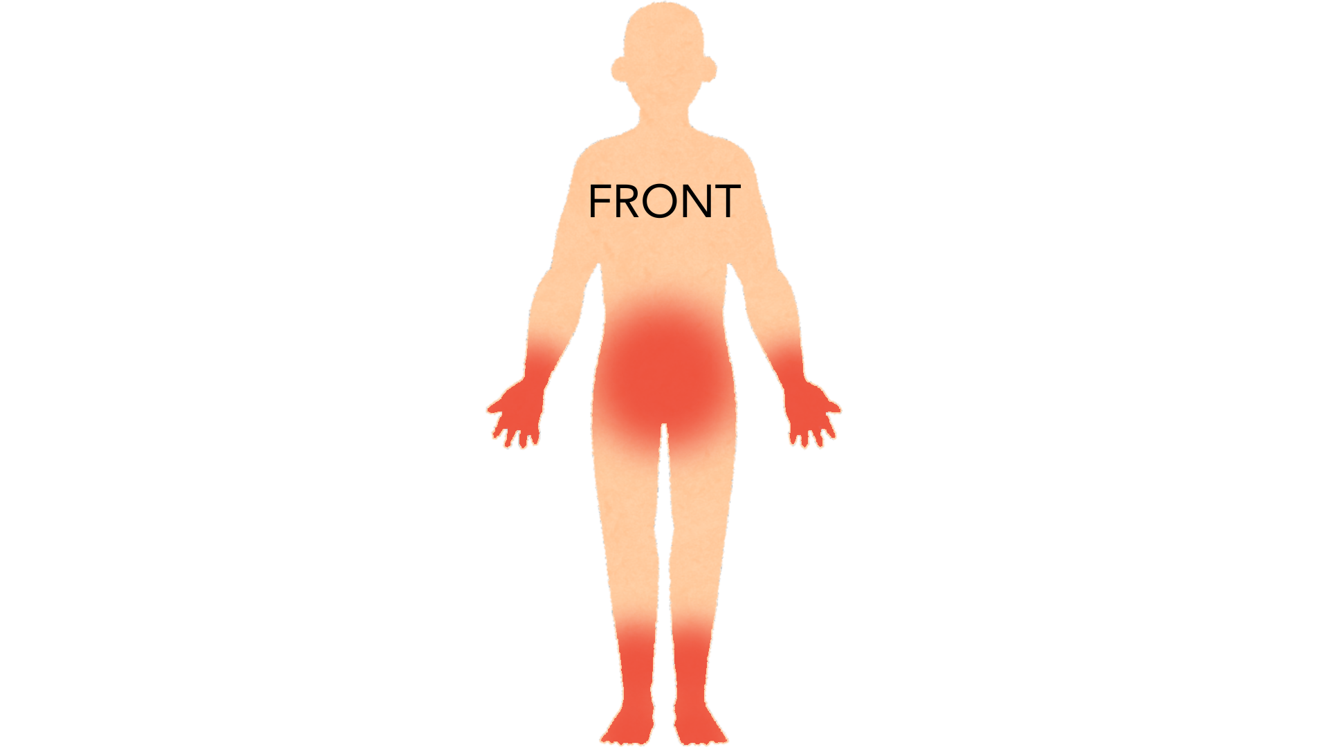 Front view of a whole body with red marks on both hands and fingers, both wrists, around the waistline, and on both feet and shins.