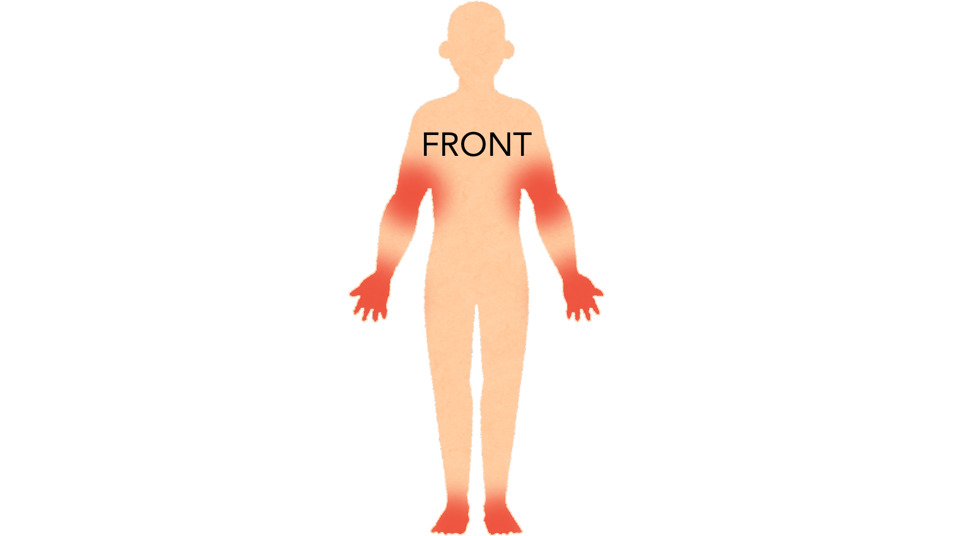 Front view of a whole body with red marks in both armpits, on both palms and on both soles. The rest of the body is clear.