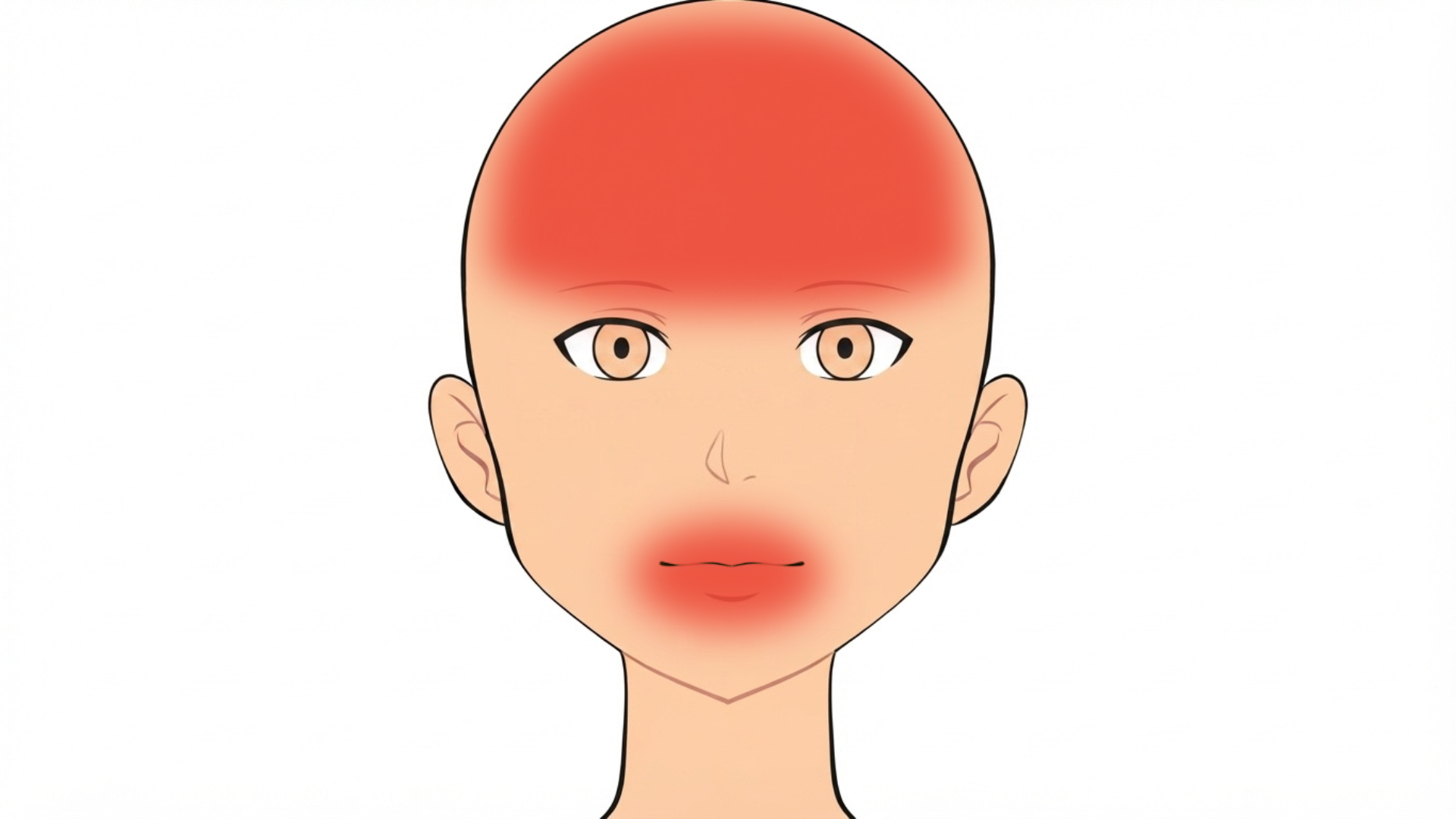 Front view of a head with red marks across the scalp and forehead and on the upper lip.